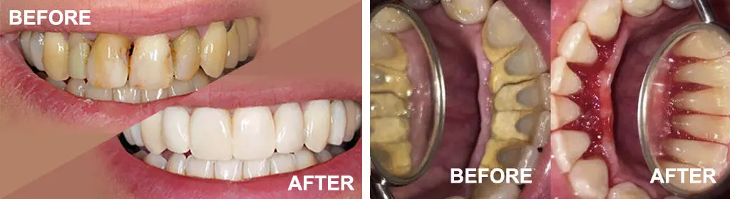 Dental Implants